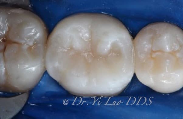 Molar Filling After