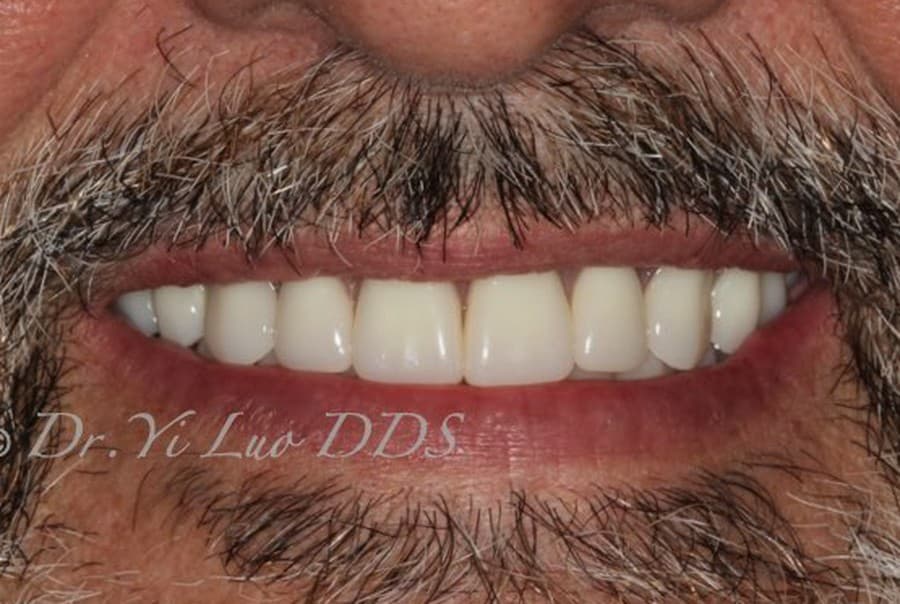 Upper Implant Overdenture and Lower Full Arch Fixed Implant Hybrid Prosthesis After