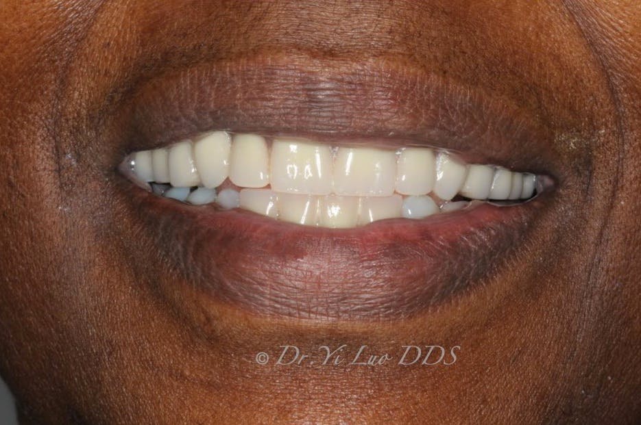 Upper Complete Denture and Lower Removable Partial Denture After