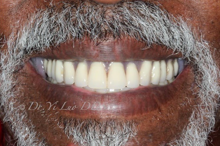 Upper and Lower Complete Dentures After