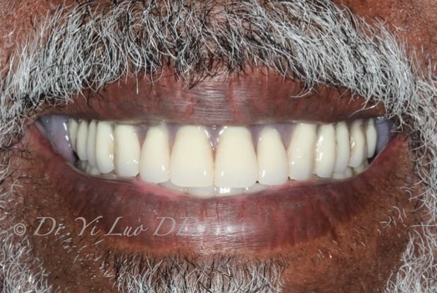 Upper and Lower Complete Dentures After