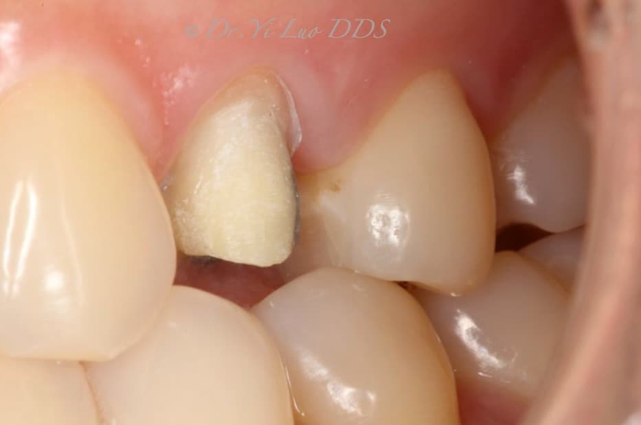 Single Crown Before