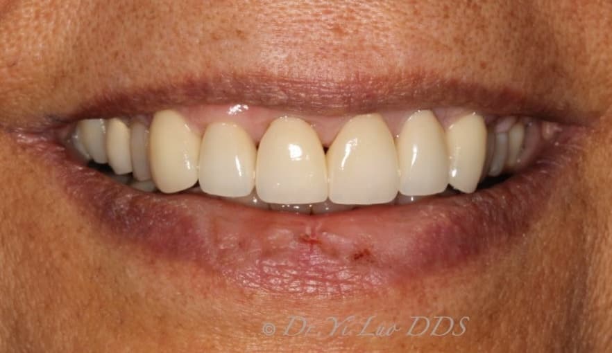 Upper Front Veneers After
