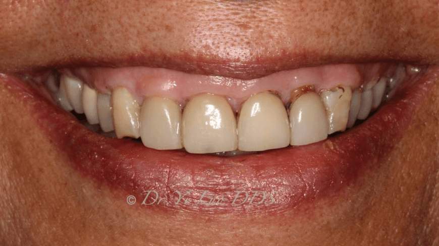 Upper Front Veneers Before