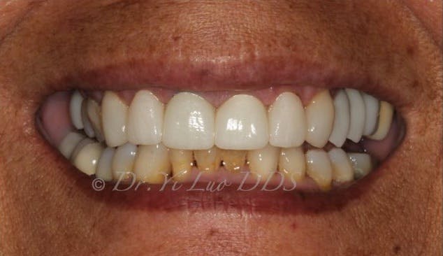 Upper Front Veneers and Crowns After
