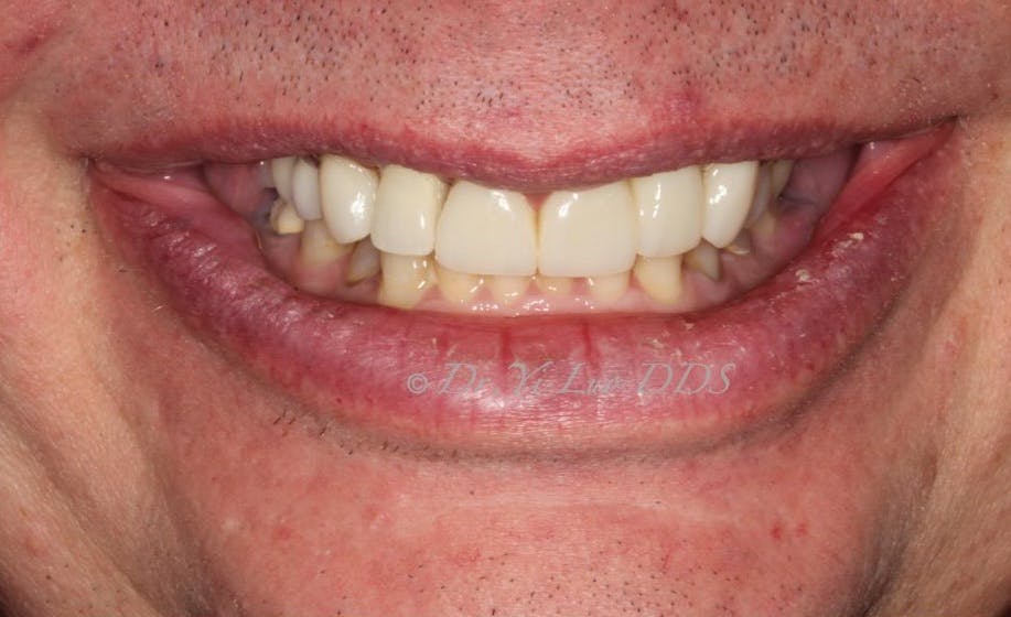 Single Implant Crown After