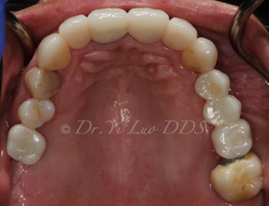 Implant Crown and Bridge After