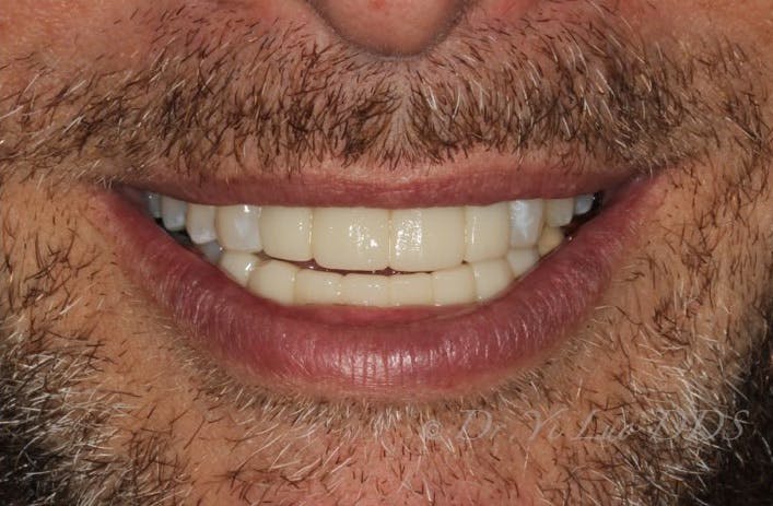 Upper and Lower Front Implant Bridge After