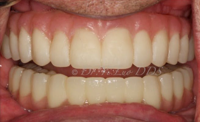 Upper and Lower All-On-X Full Arch Fixed Zirconia Implant Prostheses After